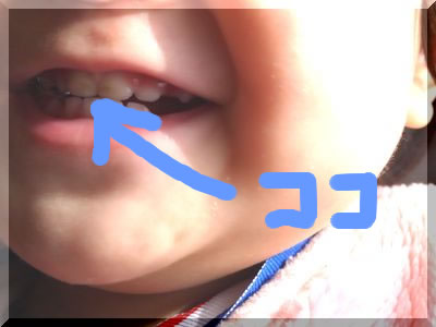 1歳児の小児歯科｜茶色い前歯の原因は虫歯じゃなくて茶渋でした