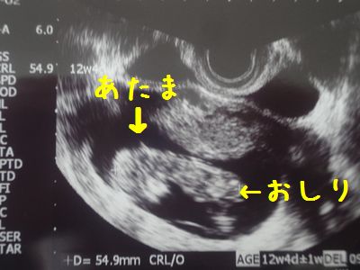 2人妊娠12週妊娠4ヶ月