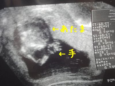 14週妊娠4ヶ月腹エコー写真